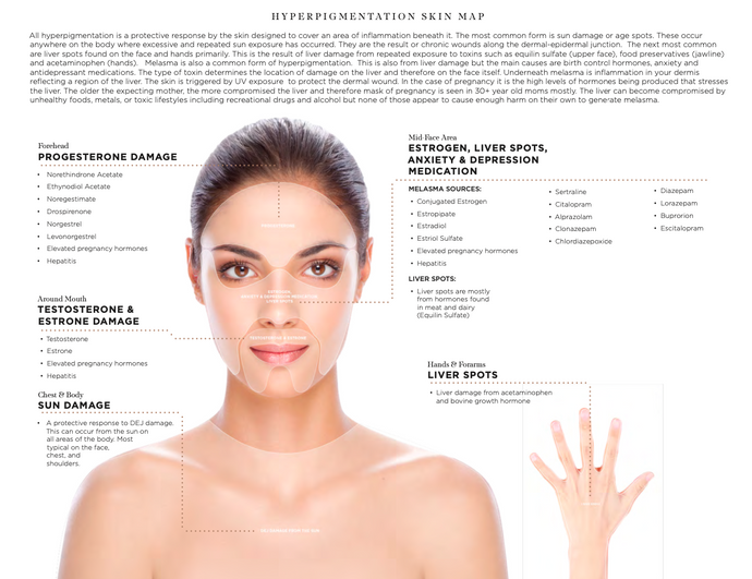 infograph for osmosis hyperpigmentation skin mapping with illustration of female and text